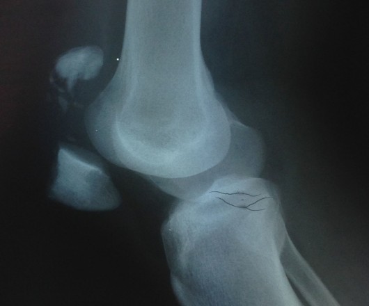 knee-fracture-x-ray